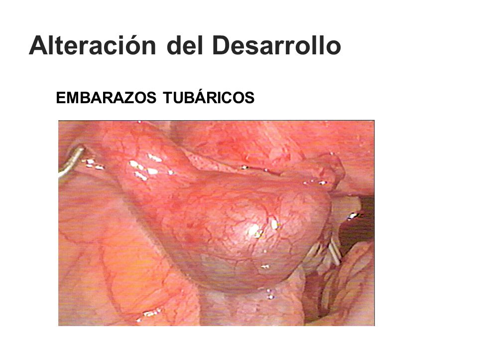 Alteración del Desarrollo