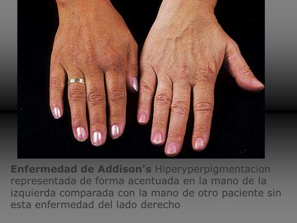 Enfermedad de Addison s Hiperyperpigmentacion representada de forma acentuada en la mano de la izquierda comparada con la mano de otro paciente sin esta enfermedad del lado derecho