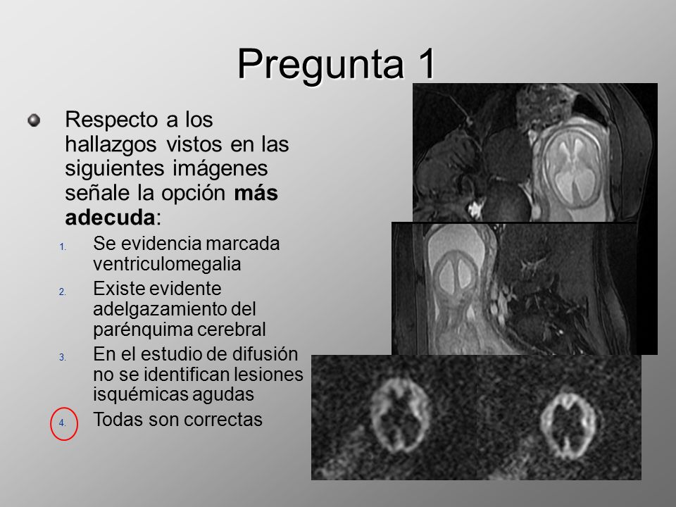 Pregunta 1 Respecto a los hallazgos vistos en las siguientes imágenes señale la opción más adecuda: