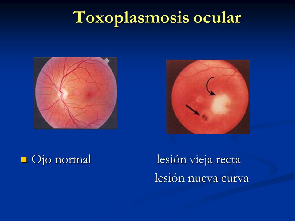 Toxoplasmosis ocular Ojo normal lesión vieja recta lesión nueva curva
