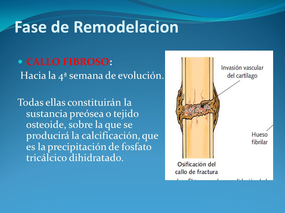 Fase de Remodelacion CALLO FIBROSO: Hacia la 4ª semana de evolución.