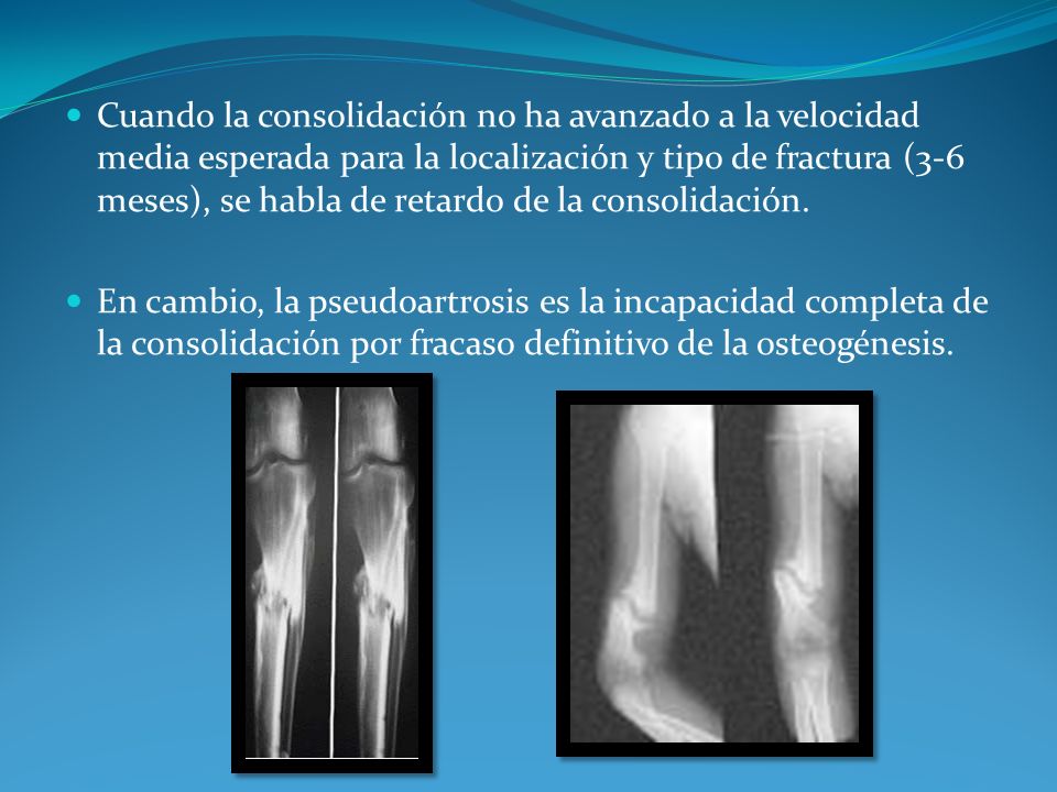 Cuando la consolidación no ha avanzado a la velocidad media esperada para la localización y tipo de fractura (3-6 meses), se habla de retardo de la consolidación.