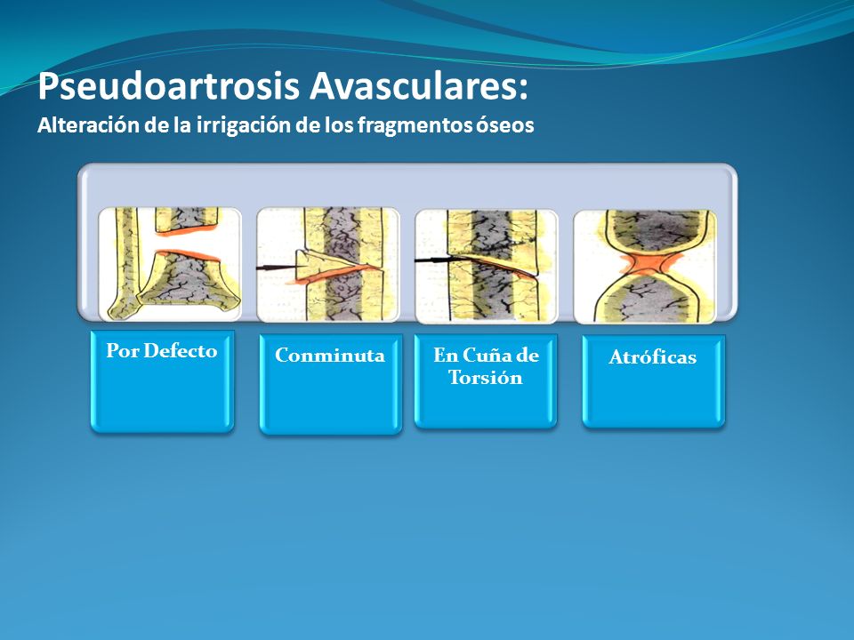 Pseudoartrosis Avasculares: Alteración de la irrigación de los fragmentos óseos