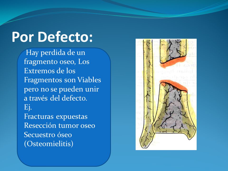 Por Defecto: Hay perdida de un fragmento oseo, Los Extremos de los Fragmentos son Viables pero no se pueden unir a través del defecto.
