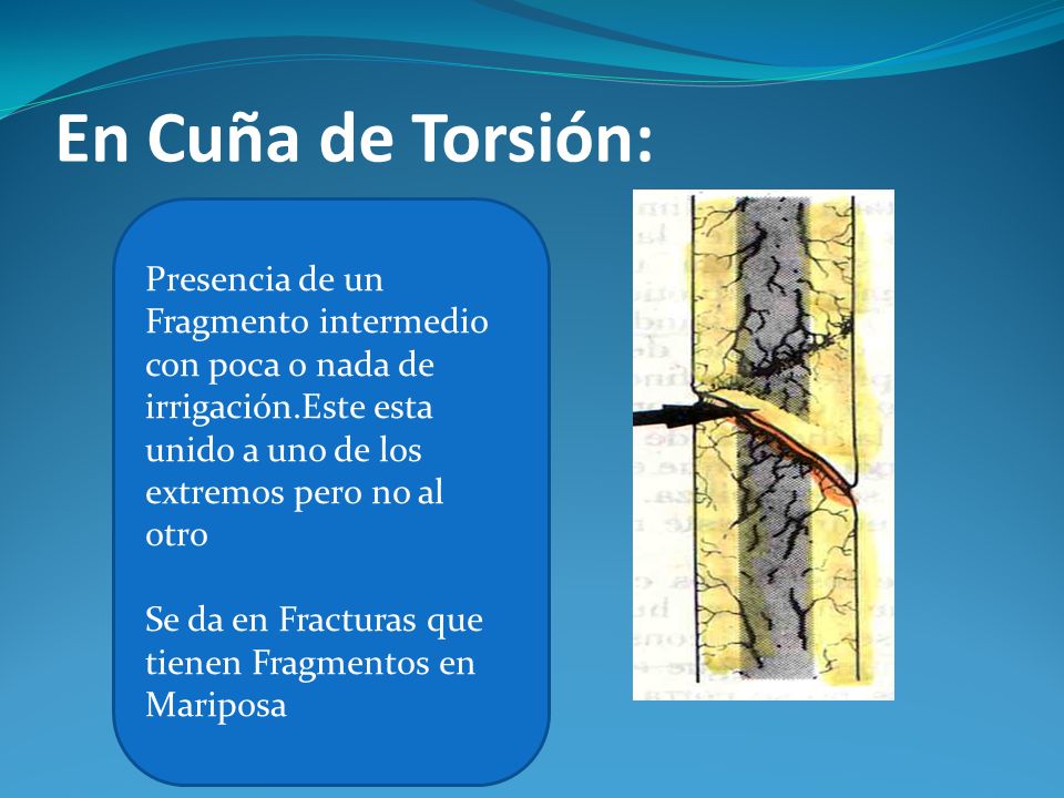 En Cuña de Torsión: Presencia de un Fragmento intermedio con poca o nada de irrigación.Este esta unido a uno de los extremos pero no al otro.