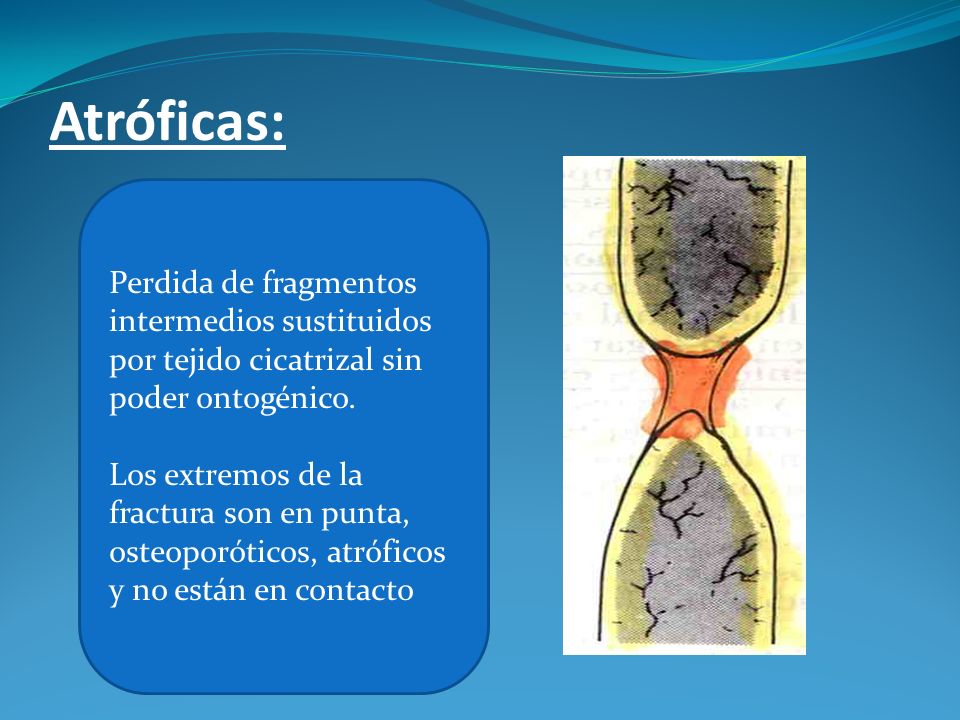 Atróficas: Perdida de fragmentos intermedios sustituidos por tejido cicatrizal sin poder ontogénico.