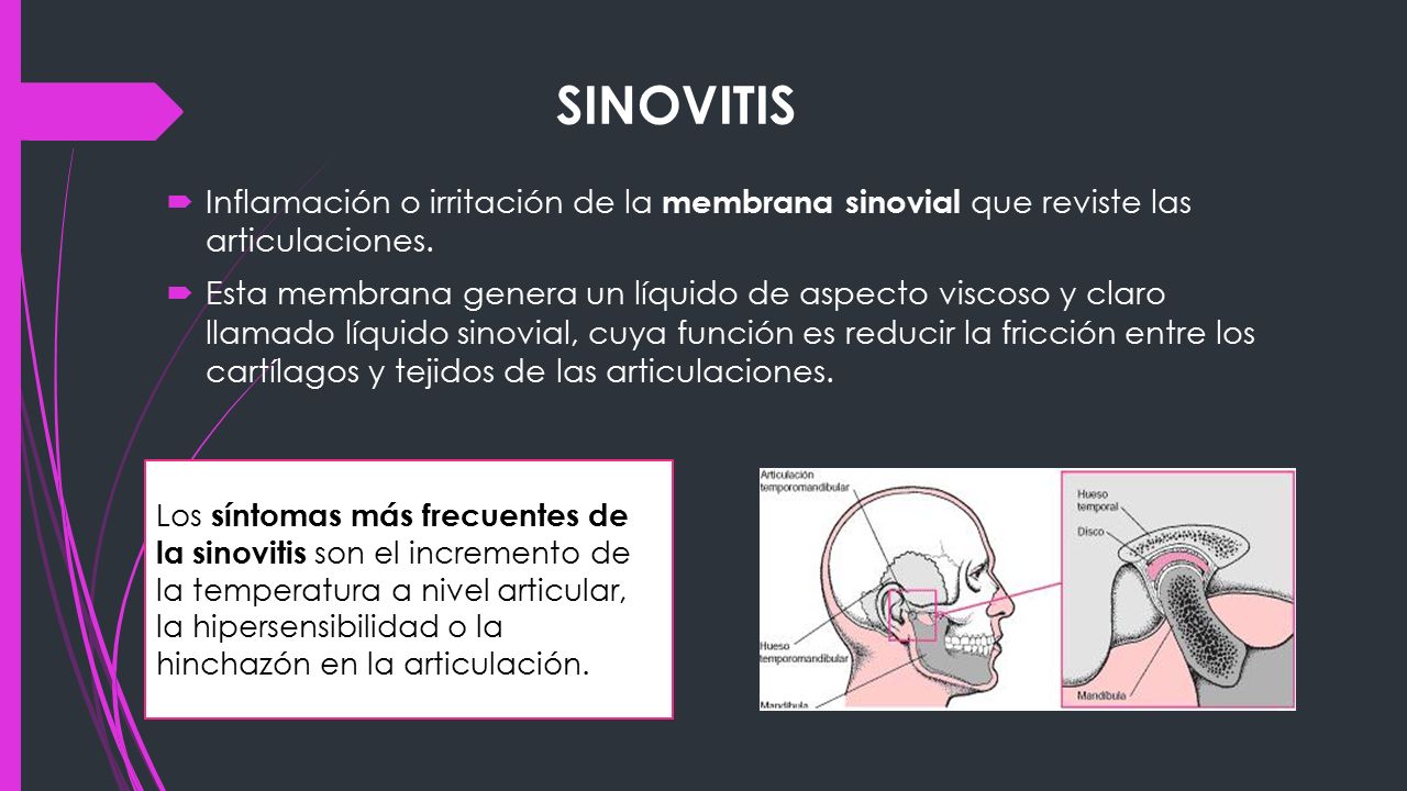 SINOVITIS Inflamación o irritación de la membrana sinovial que reviste las articulaciones.