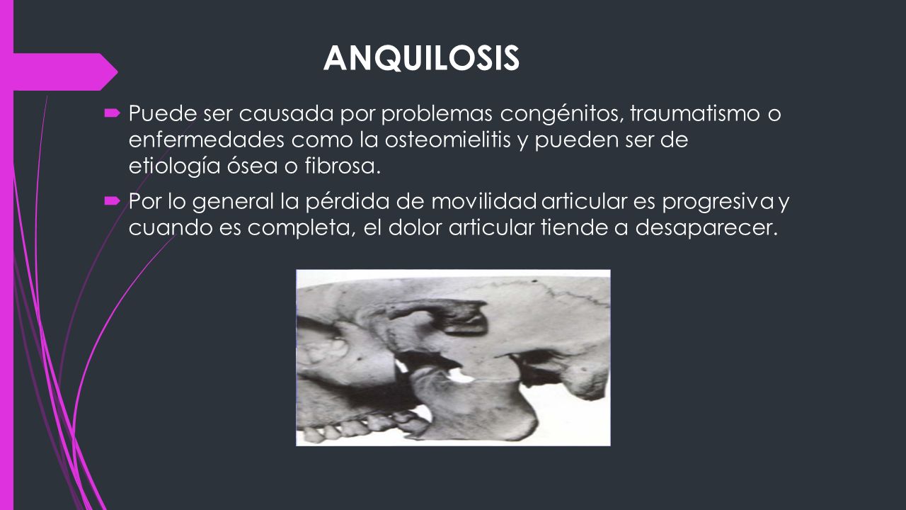ANQUILOSIS Puede ser causada por problemas congénitos, traumatismo o enfermedades como la osteomielitis y pueden ser de etiología ósea o fibrosa.