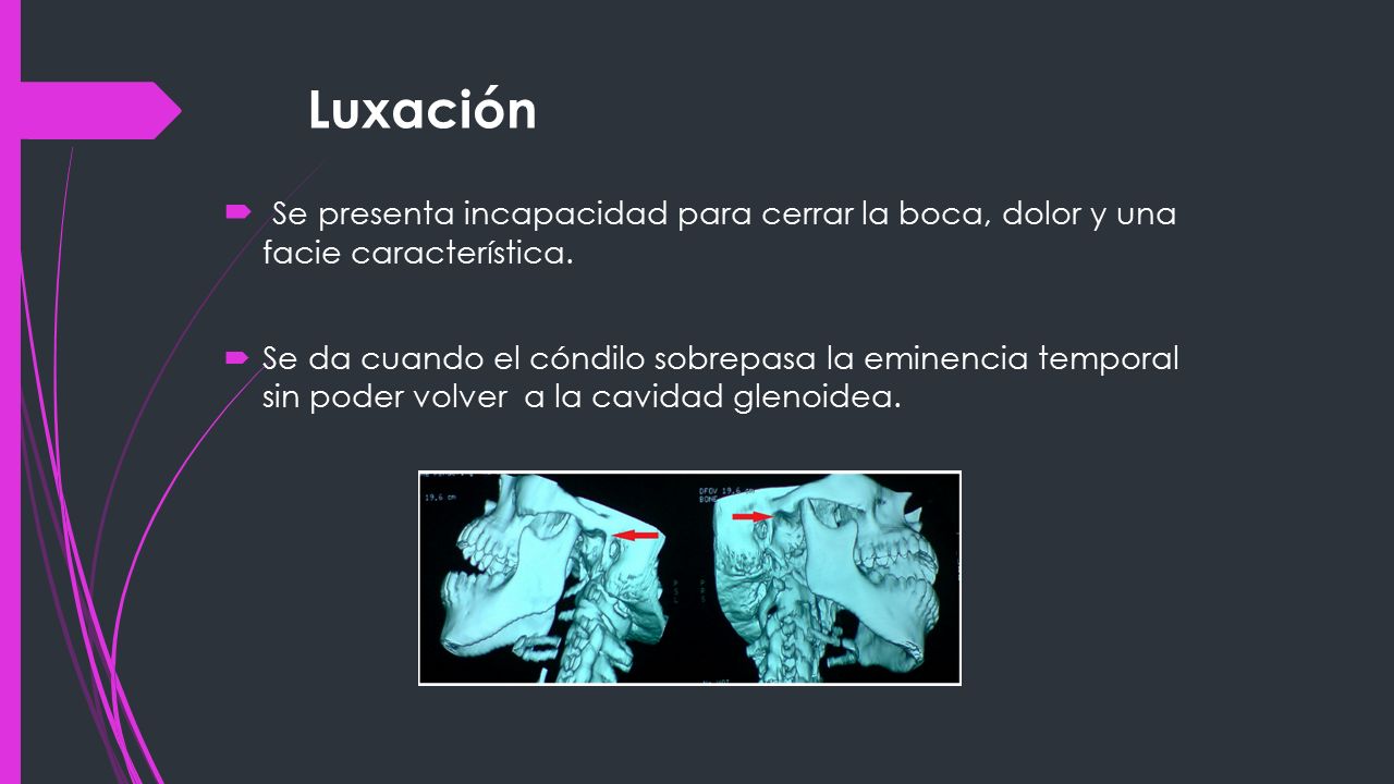 Luxación Se presenta incapacidad para cerrar la boca, dolor y una facie característica.