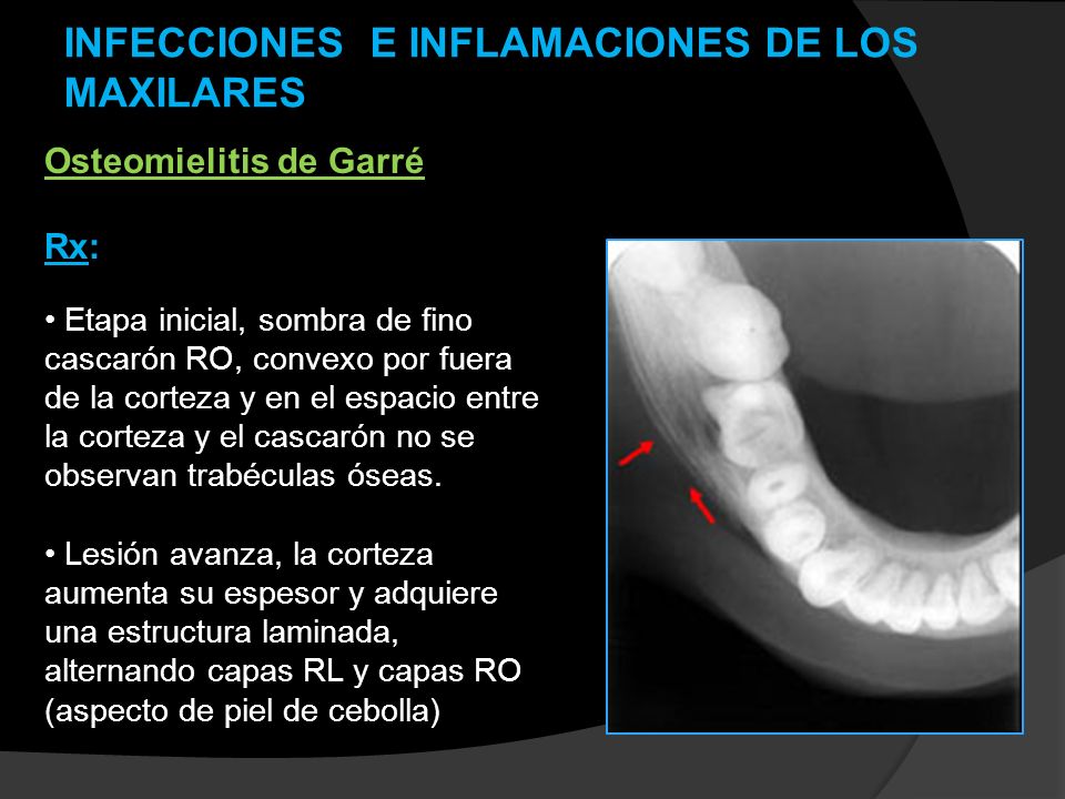 INFECCIONES E INFLAMACIONES DE LOS MAXILARES