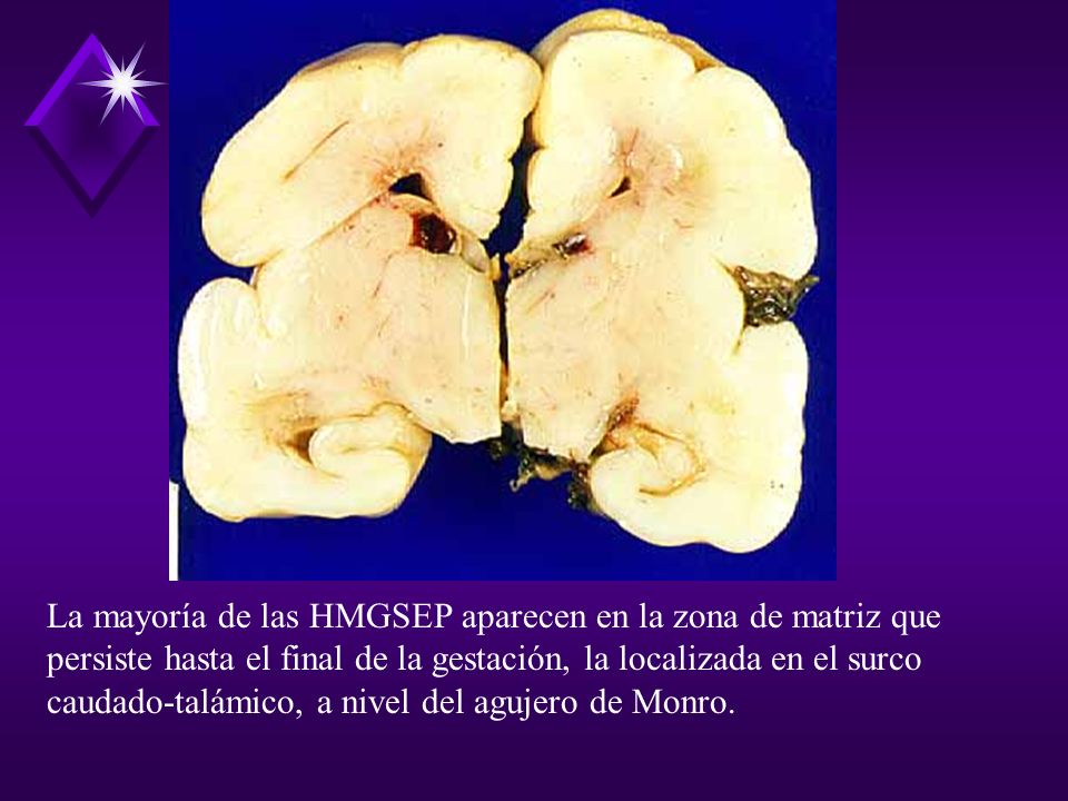 La mayoría de las HMGSEP aparecen en la zona de matriz que persiste hasta el final de la gestación, la localizada en el surco caudado-talámico, a nivel del agujero de Monro.