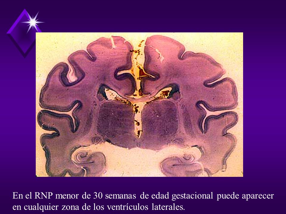 En el RNP menor de 30 semanas de edad gestacional puede aparecer en cualquier zona de los ventrículos laterales.