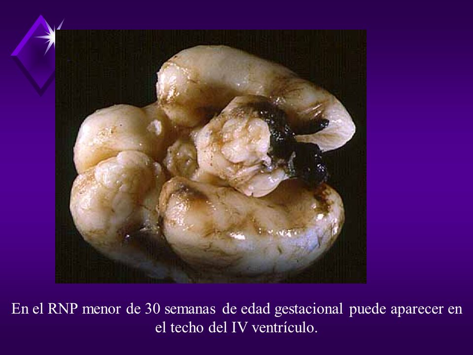 En el RNP menor de 30 semanas de edad gestacional puede aparecer en el techo del IV ventrículo.