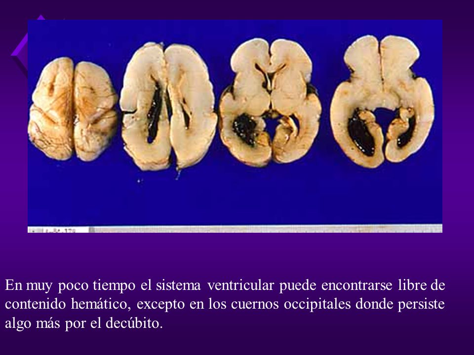 En muy poco tiempo el sistema ventricular puede encontrarse libre de contenido hemático, excepto en los cuernos occipitales donde persiste algo más por el decúbito.