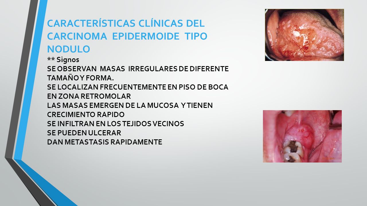 CARACTERÍSTICAS CLÍNICAS DEL CARCINOMA EPIDERMOIDE TIPO NODULO