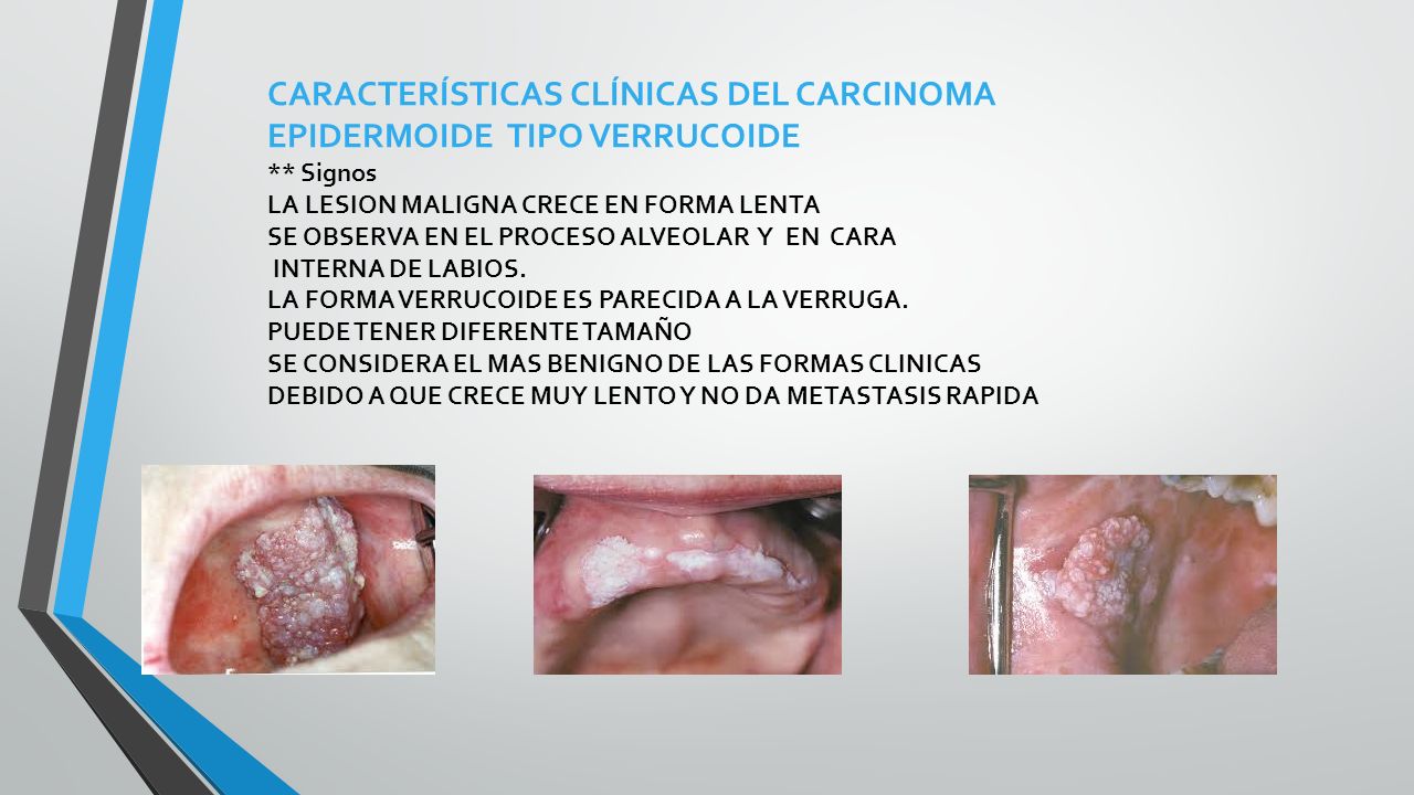 CARACTERÍSTICAS CLÍNICAS DEL CARCINOMA EPIDERMOIDE TIPO VERRUCOIDE
