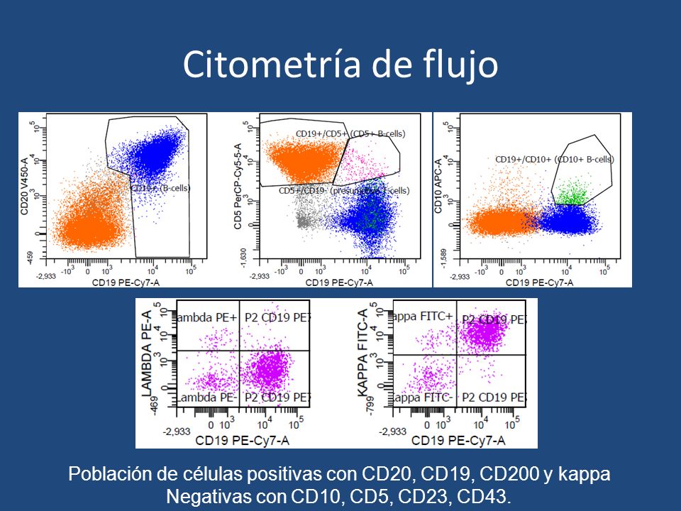 Citometría de flujo Población de células positivas con CD20, CD19, CD200 y kappa.