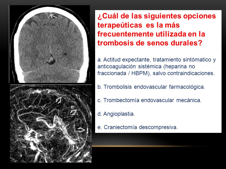 ¿Cuál de las siguientes opciones terapeúticas es la más frecuentemente utilizada en la trombosis de senos durales