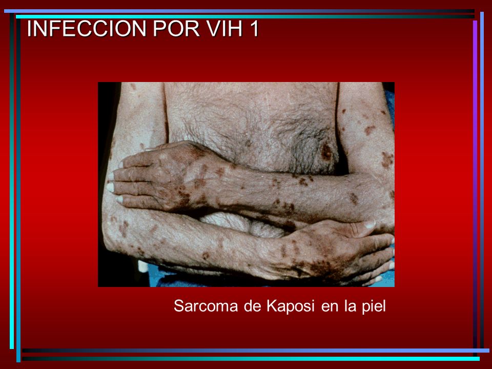 INFECCION POR VIH 1 Sarcoma de Kaposi en la piel