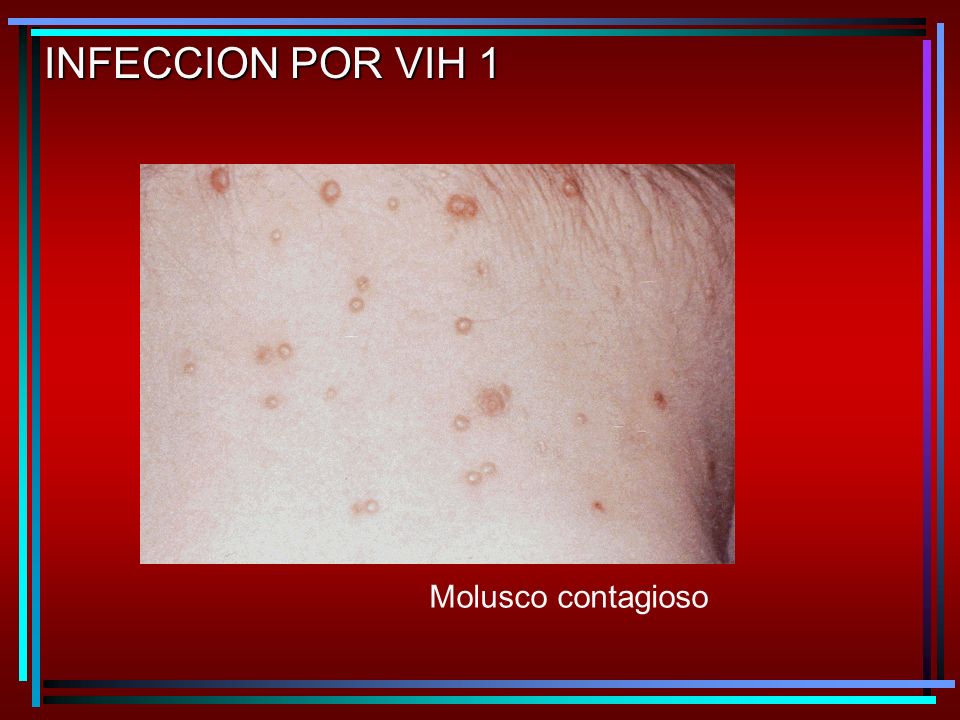 INFECCION POR VIH 1 Molusco contagioso