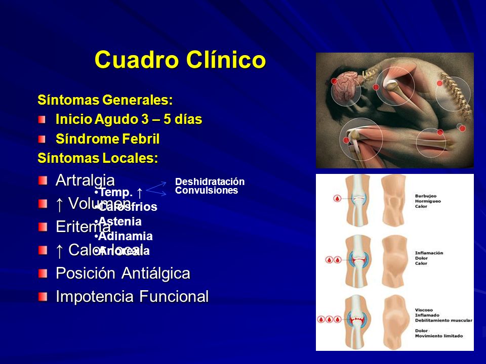 Cuadro Clínico Artralgia ↑ Volumen Eritema ↑ Calor local