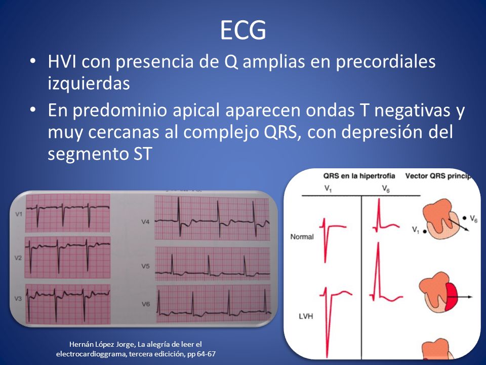 ECG HVI con presencia de Q amplias en precordiales izquierdas