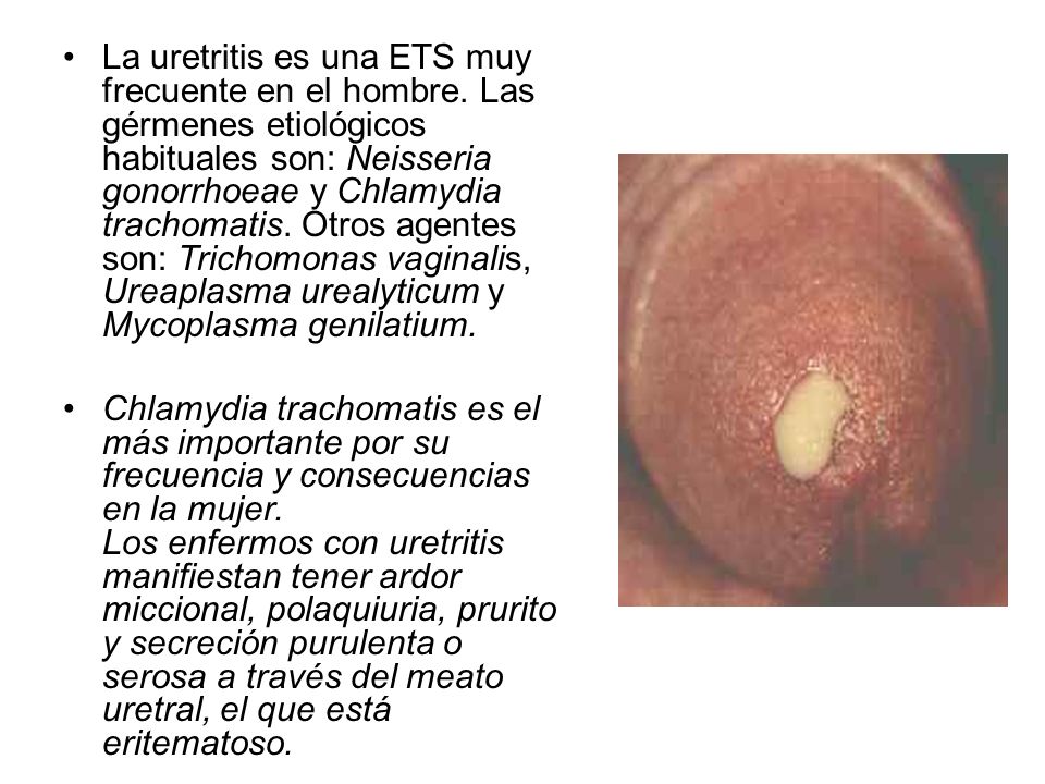 La uretritis es una ETS muy frecuente en el hombre