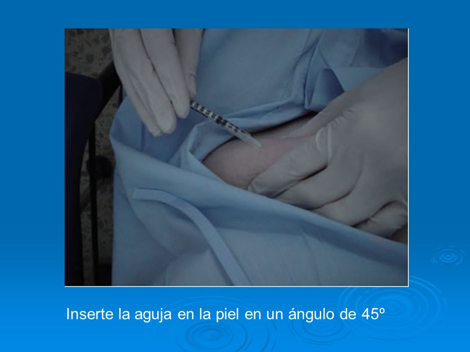 Inserte la aguja en la piel en un ángulo de 45º