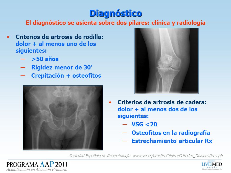 El diagnóstico se asienta sobre dos pilares: clínica y radiología