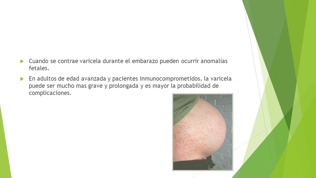 Cuando se contrae varicela durante el embarazo pueden ocurrir anomalías fetales.