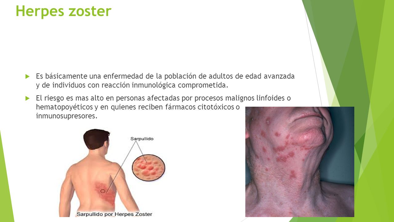 Herpes zoster Es básicamente una enfermedad de la población de adultos de edad avanzada y de individuos con reacción inmunológica comprometida.