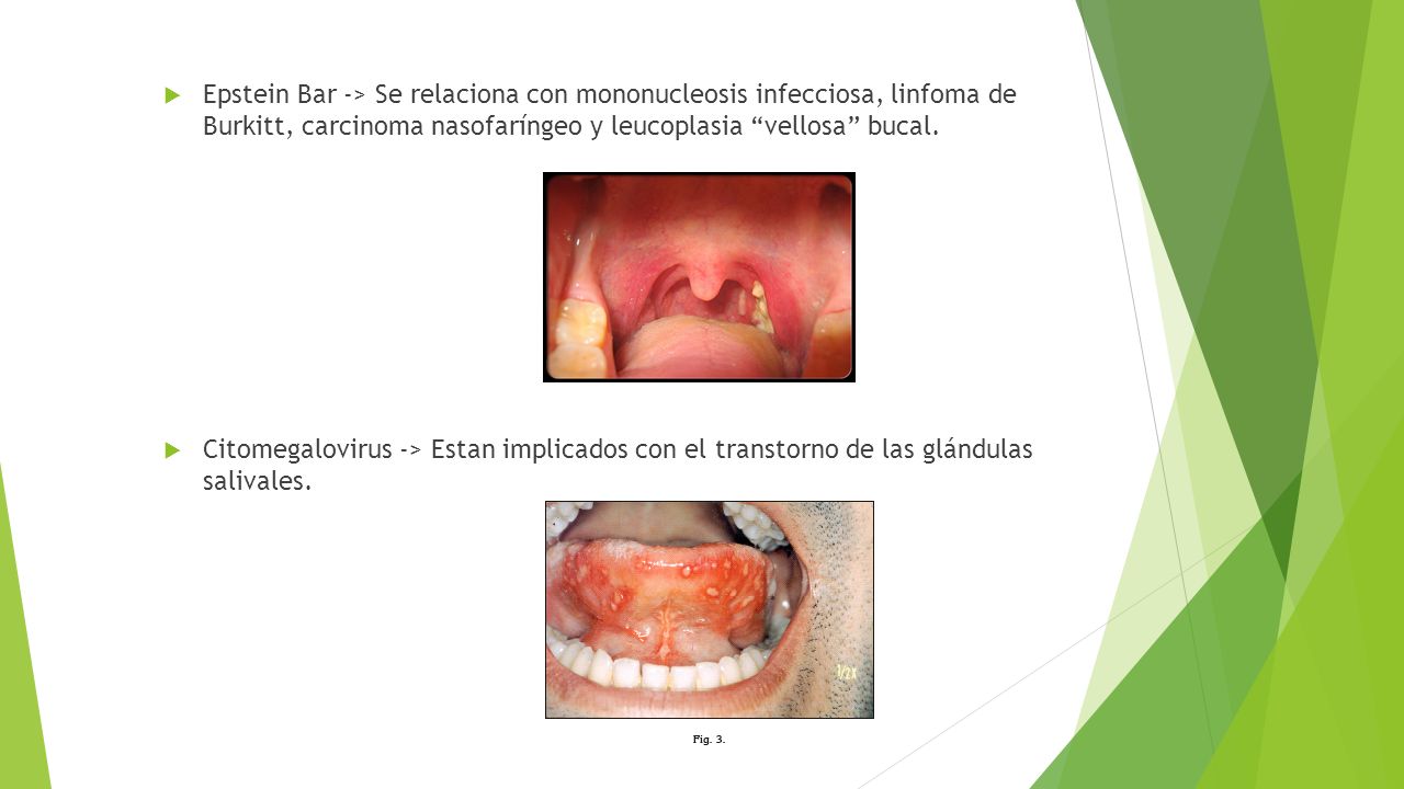 Epstein Bar -> Se relaciona con mononucleosis infecciosa, linfoma de Burkitt, carcinoma nasofaríngeo y leucoplasia vellosa bucal.