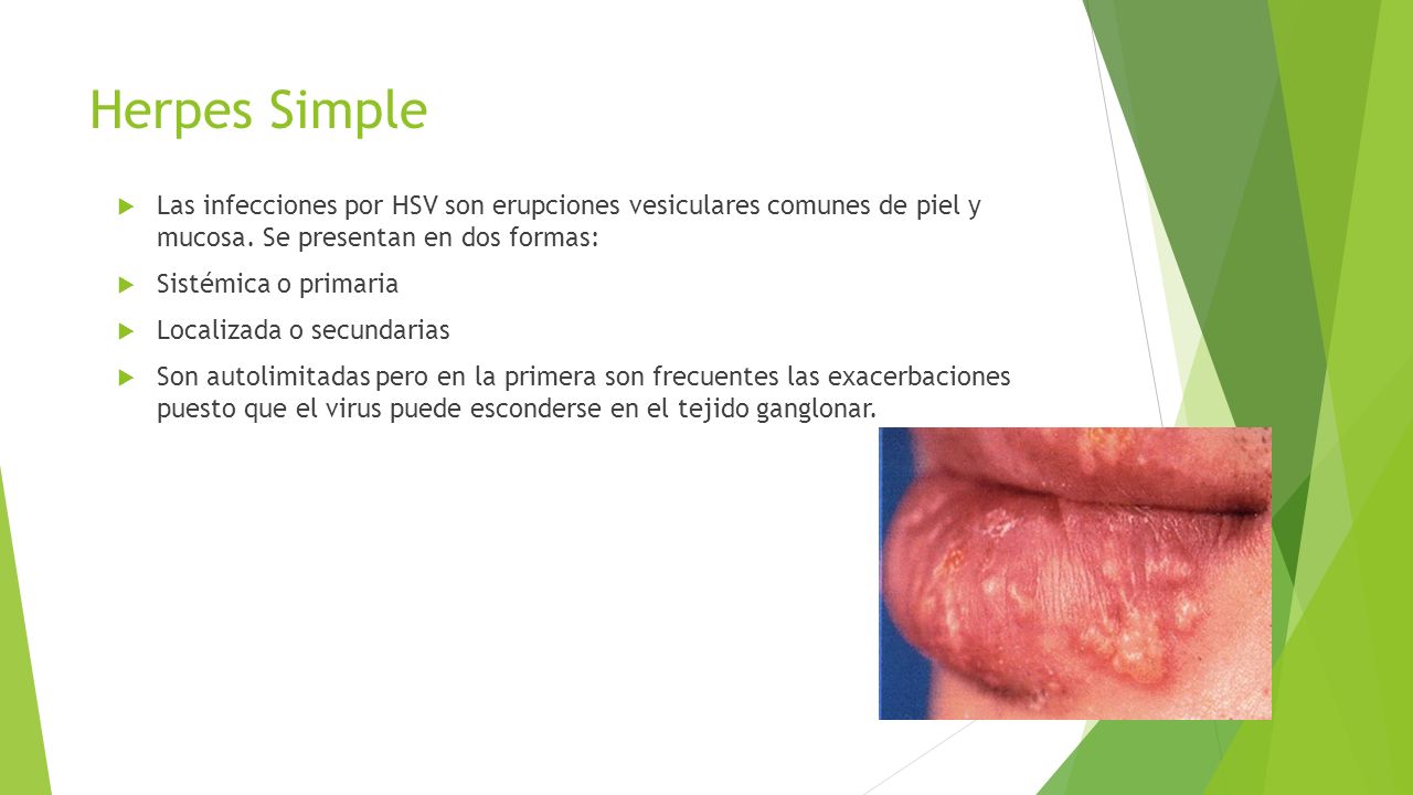 Herpes Simple Las infecciones por HSV son erupciones vesiculares comunes de piel y mucosa. Se presentan en dos formas:
