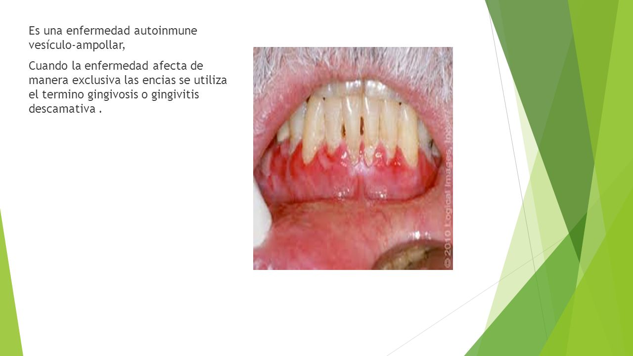 Es una enfermedad autoinmune vesículo-ampollar, Cuando la enfermedad afecta de manera exclusiva las encias se utiliza el termino gingivosis o gingivitis descamativa .