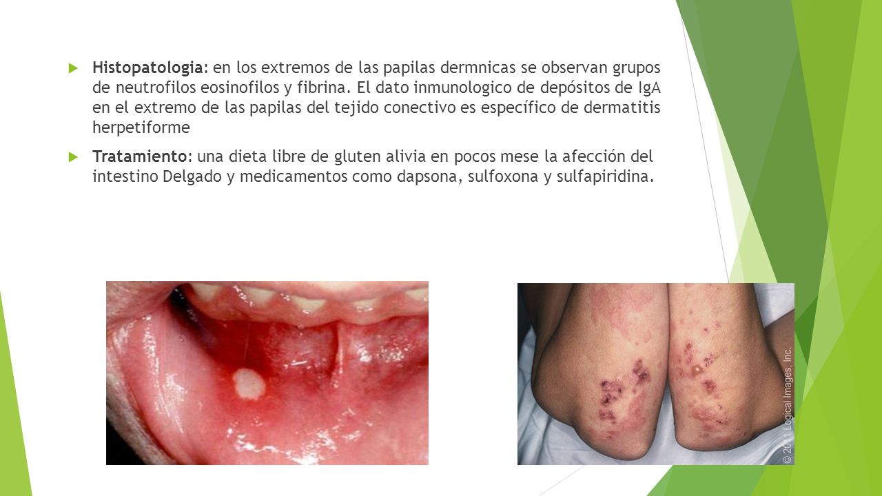 Histopatologia: en los extremos de las papilas dermnicas se observan grupos de neutrofilos eosinofilos y fibrina. El dato inmunologico de depósitos de IgA en el extremo de las papilas del tejido conectivo es específico de dermatitis herpetiforme