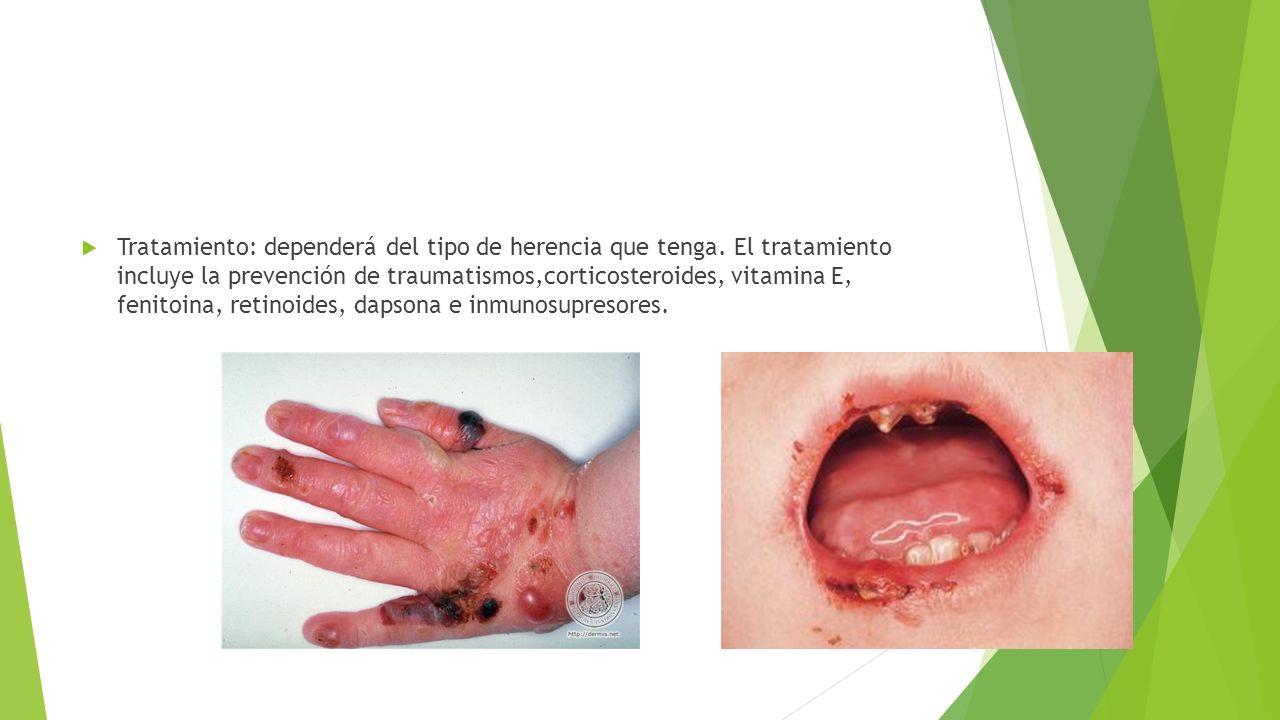 Tratamiento: dependerá del tipo de herencia que tenga