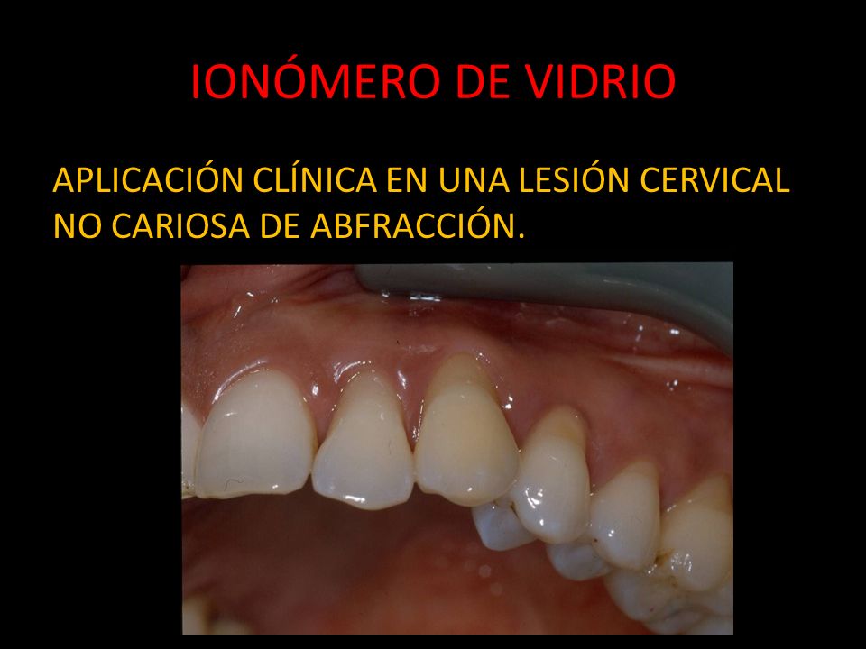 IONÓMERO DE VIDRIO APLICACIÓN CLÍNICA EN UNA LESIÓN CERVICAL NO CARIOSA DE ABFRACCIÓN.
