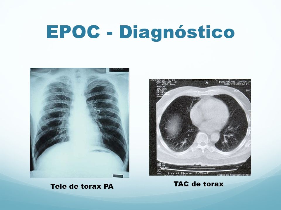 EPOC - Diagnóstico TAC de torax Tele de torax PA