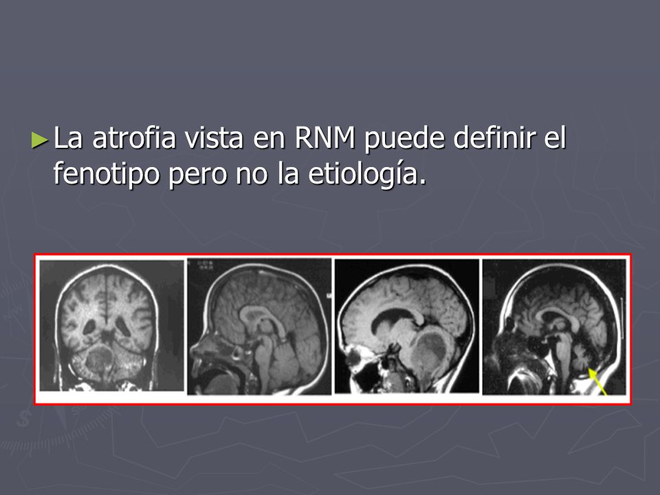 La atrofia vista en RNM puede definir el fenotipo pero no la etiología.