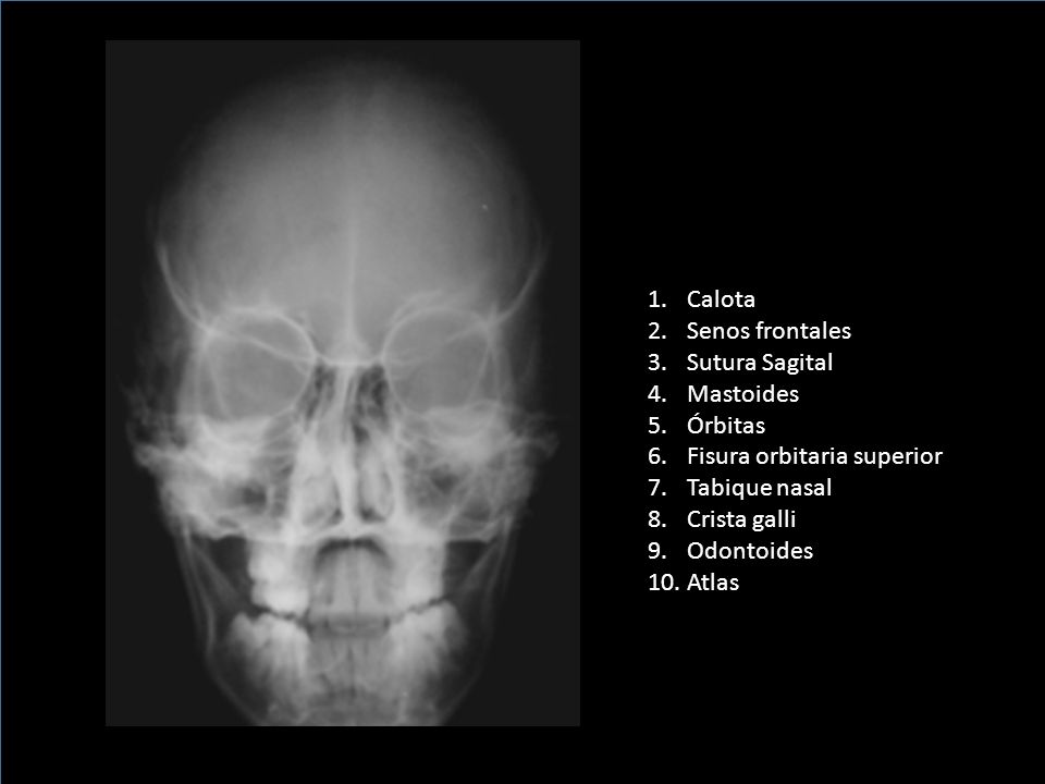 Calota Senos frontales. Sutura Sagital. Mastoides. Órbitas. Fisura orbitaria superior. Tabique nasal.