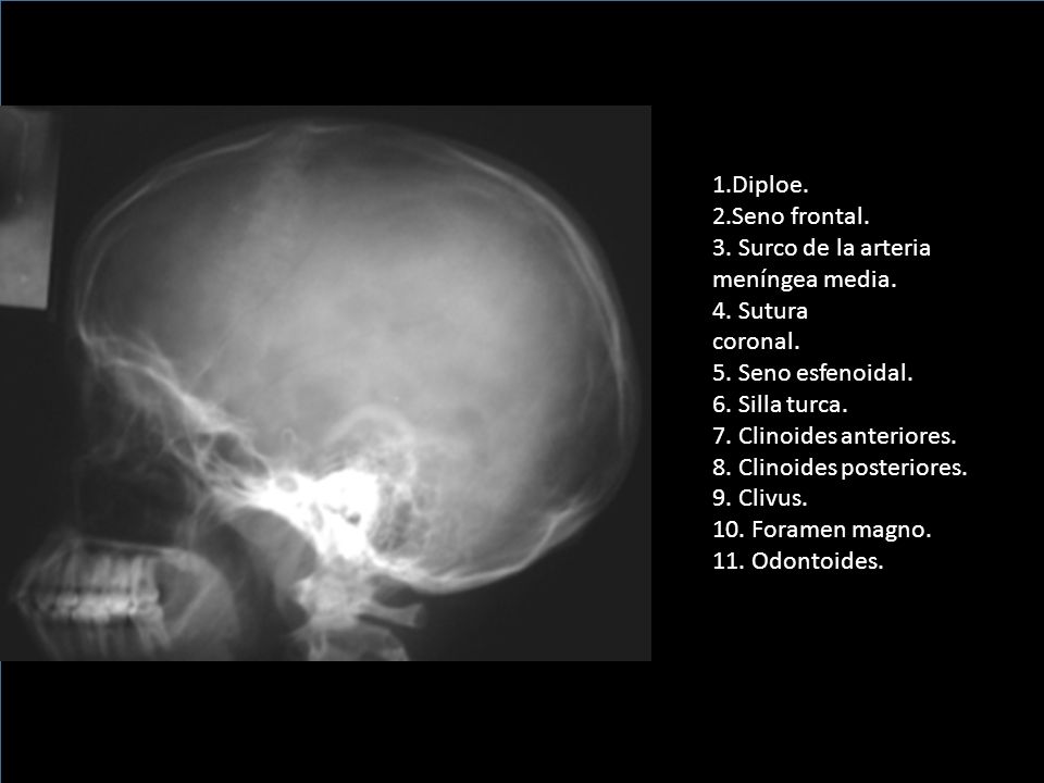 1.Diploe. 2.Seno frontal. 3. Surco de la arteria meníngea media. 4. Sutura.