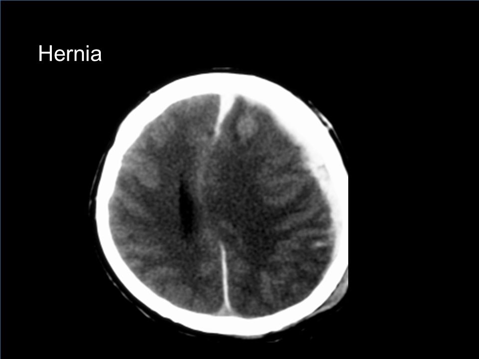 Hernia