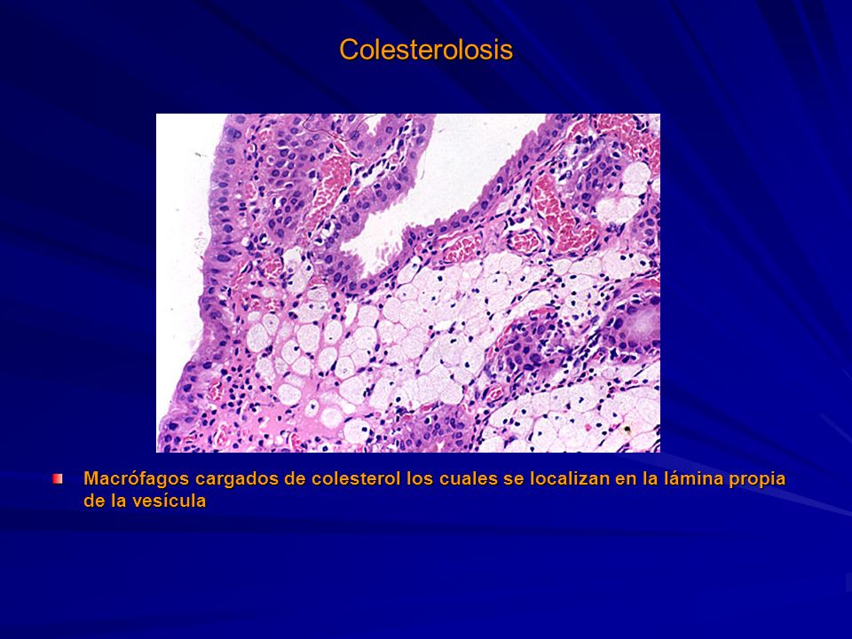 Colesterolosis Macrófagos cargados de colesterol los cuales se localizan en la lámina propia de la vesícula.