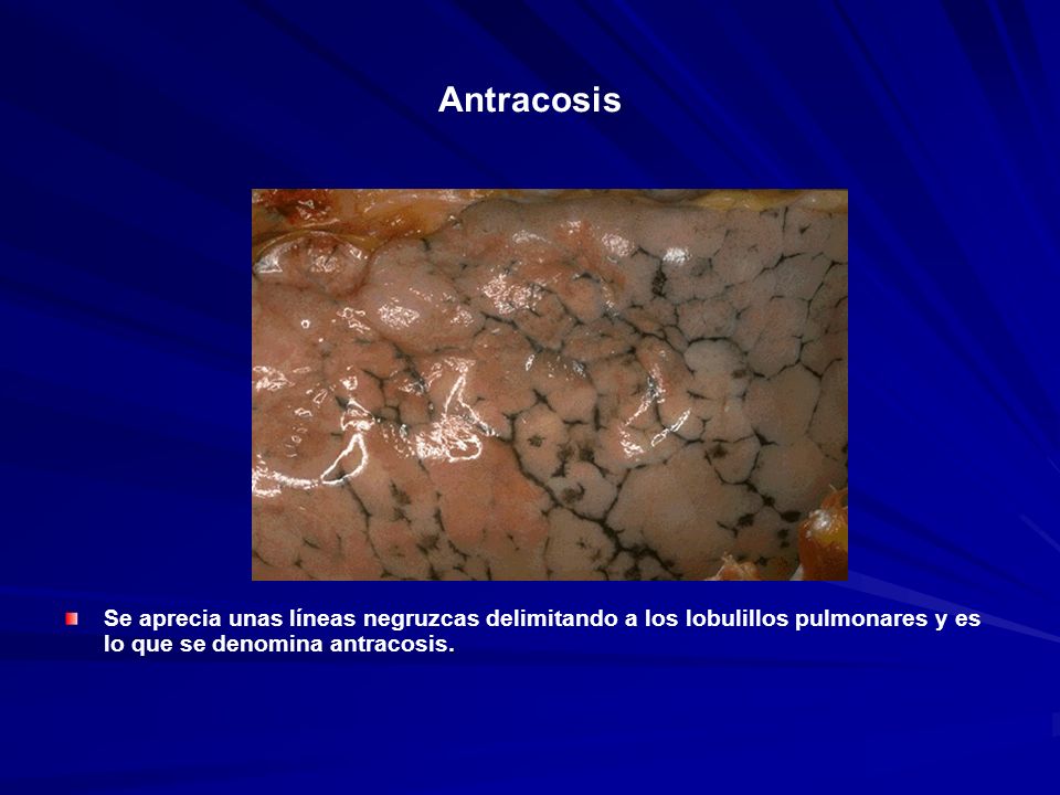 Antracosis Se aprecia unas líneas negruzcas delimitando a los lobulillos pulmonares y es lo que se denomina antracosis.