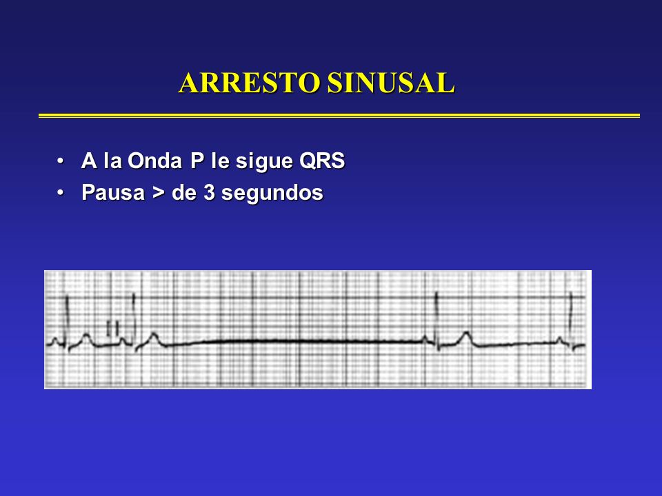 ARRESTO SINUSAL A la Onda P le sigue QRS Pausa > de 3 segundos