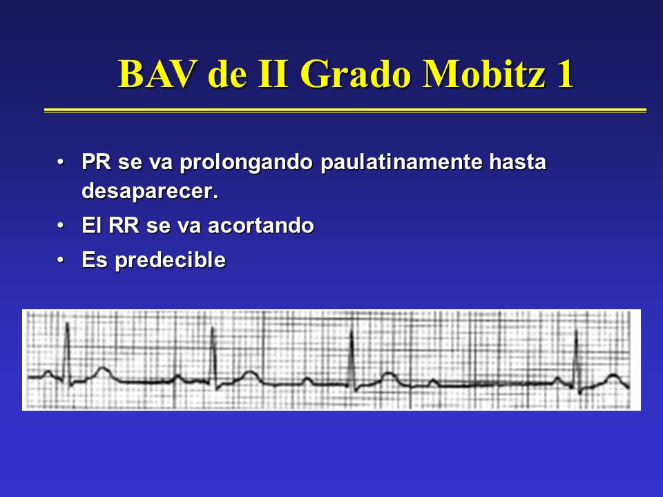 BAV de II Grado Mobitz 1 PR se va prolongando paulatinamente hasta desaparecer. El RR se va acortando.