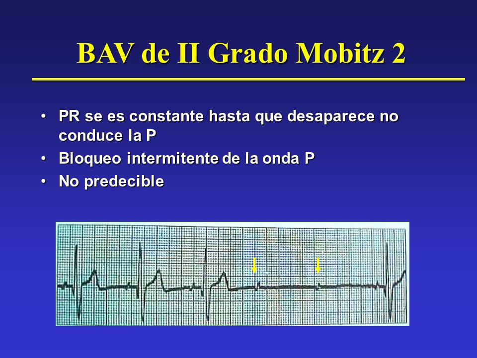 BAV de II Grado Mobitz 2 PR se es constante hasta que desaparece no conduce la P. Bloqueo intermitente de la onda P.