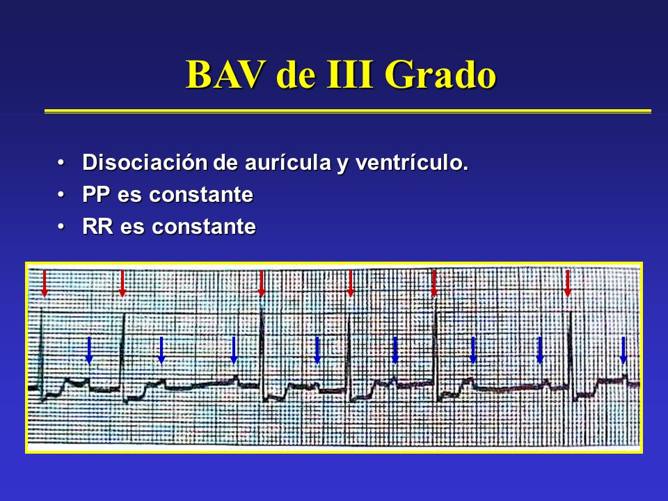 BAV de III Grado Disociación de aurícula y ventrículo. PP es constante