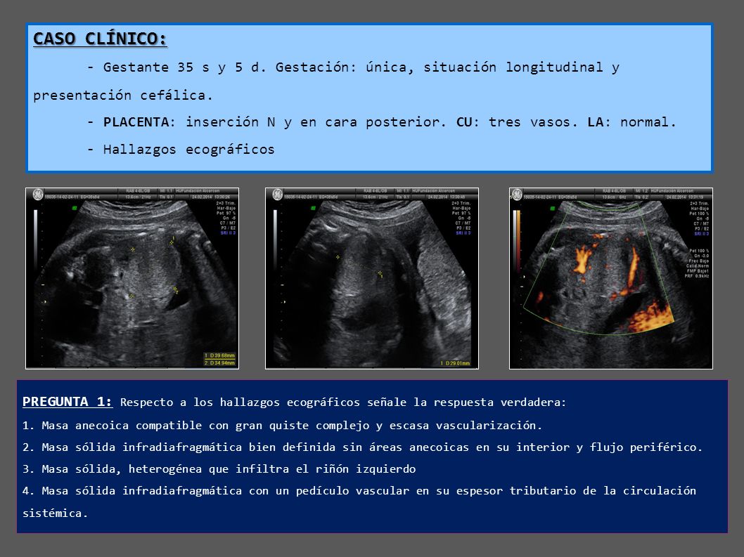 22 CASO CLÍNICO: - Gestante 35 s y 5 d. Gestación: única, situación longitudinal y presentación cefálica.