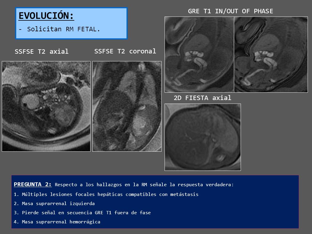 EVOLUCIÓN: GRE T1 IN/OUT OF PHASE Solicitan RM FETAL. SSFSE T2 axial
